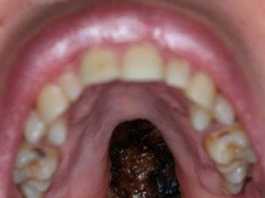 Damaged palate