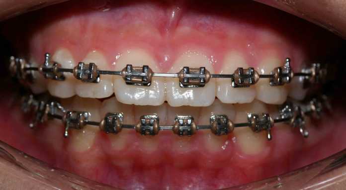 orthodontic treatment