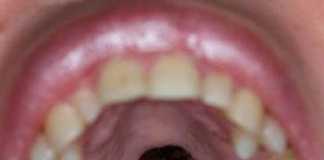 Damaged palate