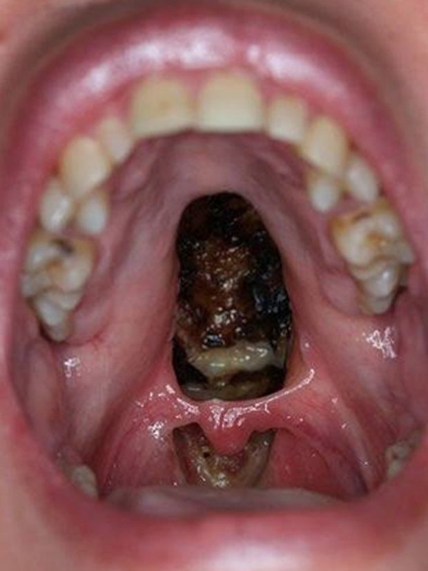 Damaged palate