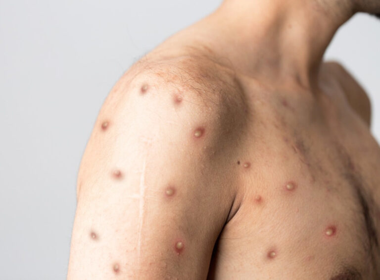 Monkeypox cases confirmed in Mid-West