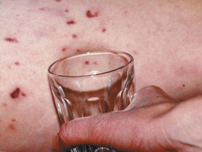 Public health alert after young woman dies of meningitis in Limerick