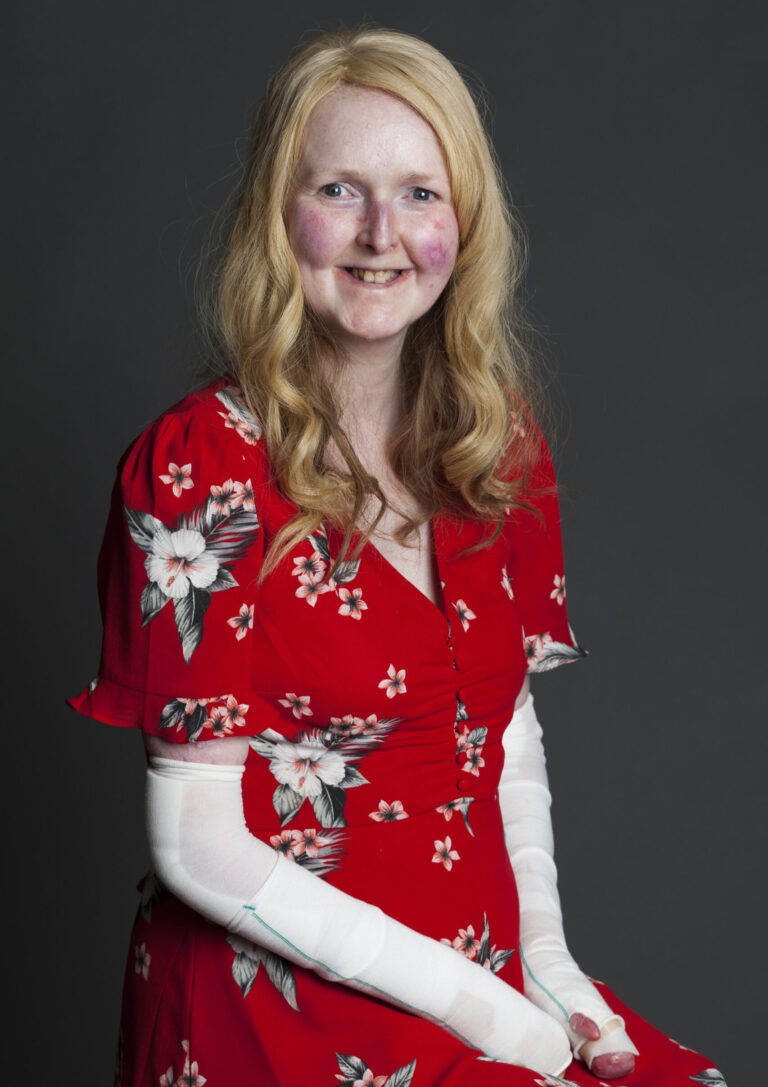 UL report shows patients with skin-splitting disease don’t even get bandages