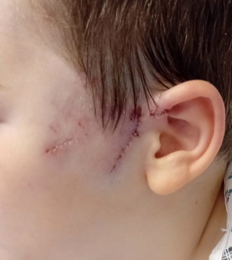 ‘The dog tore the face off him’: Boy left with 30 stitches after another dog attack in Limerick